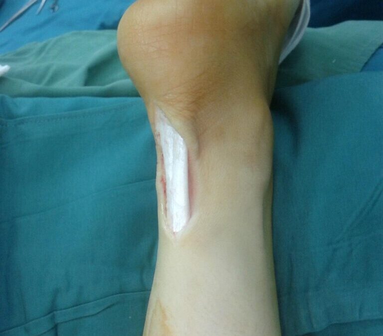 Tendons: Let’s Talk About Tendons: The Unsung Heroes Of Your…